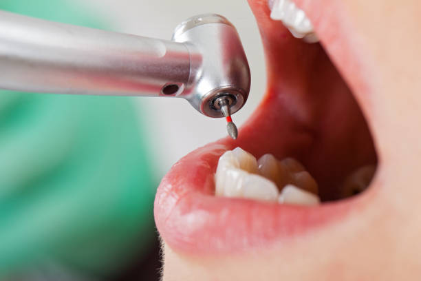 Best Emergency Dental Extractions in Chester Center, CT